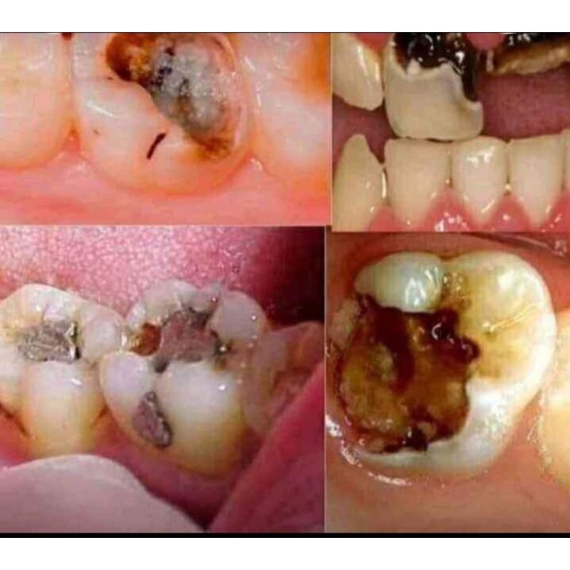 OBAT SAKIT GIGI, GIGI BERLUBANG, Perontok karang gigi