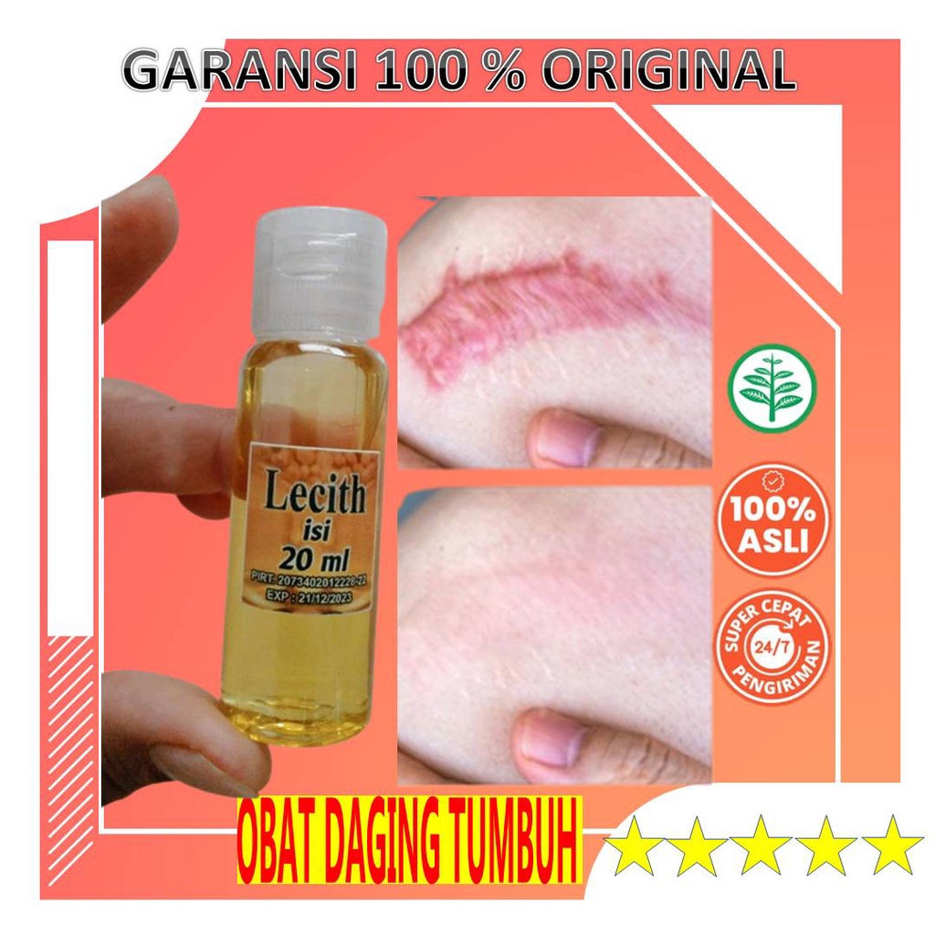 Minyak Obat Penghilang Keloid Yang Sudah Lama Luka Bakar Bagus Scar Krim Keloid Salep Serum Obat Pen