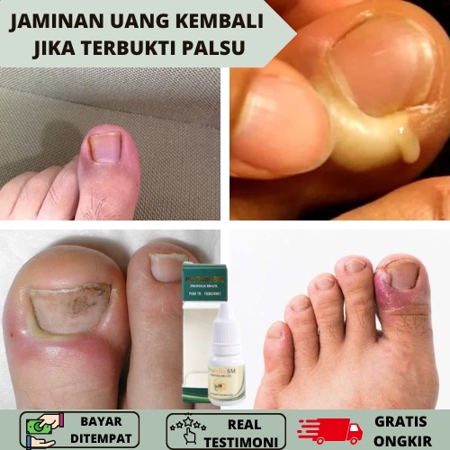 PROPOLIS SM, Obat Herbal Cantengan, Obat Cantengan, Obat Kuku Cantengan, Obat Cantengan Jempol Kaki,