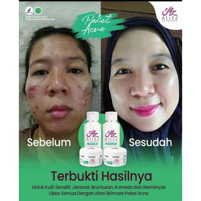 Aliza Skincare Paket Acne