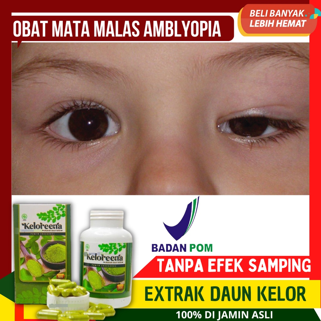 OBAT MATA MALAS - MATA TIDAK FOKUS SEBELAH amblyopia  - Perbedaan kecerahan penglihatan di mata kana