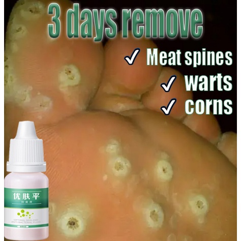 Cairan Obat Untuk Kutil Plester Kutil Mata Ikan Kaki Kapalan Ji Yan Gao Obat Kutil Kapalan Mata Ikan Kaki Callusol / Calusol / Kalusol (Mata Ikan Kalusol, Obat Kutil)