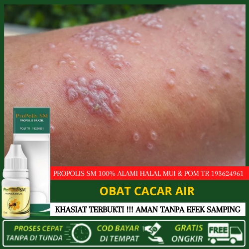 Propolis SM Obat [ Bukan Salep ] Penghilang Bekas Cacar Air Anak Di Muka Wajah Berlubang Tampek Anak