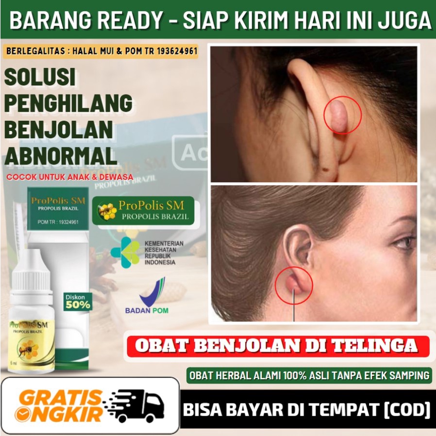 Obat Keloid Bernanah di Daun Telinga, Obat Oles Pengempis Benjolan Telinga, Penghilang Keloid Teling