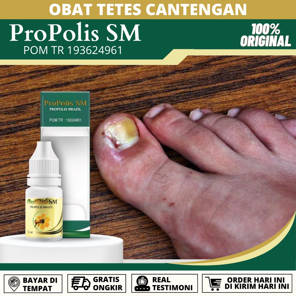 Jual Obat Tetes Cantengan Jempol Kaki Cantengan Pada Kuku Kaki