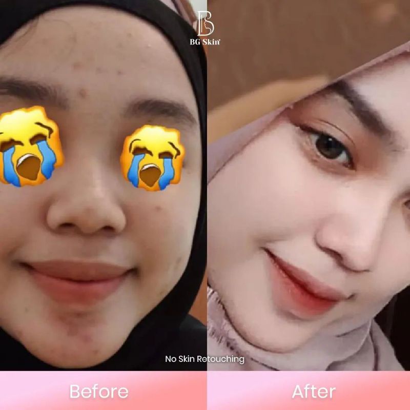 BG SKIN PAKET WAJAH  PAKET ACNE LUXURY ACNEPRONE SKIN
