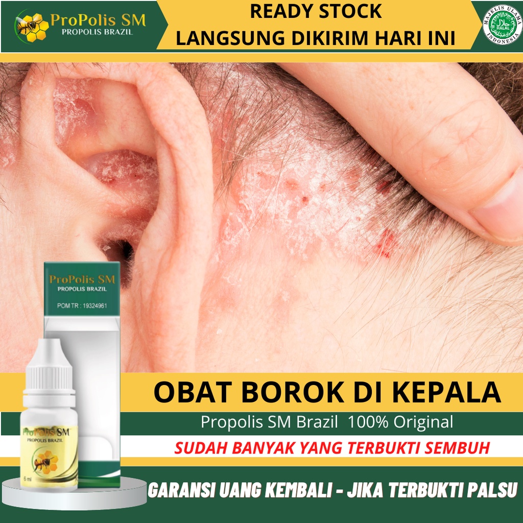 Obat Psoriasis Kulit Kepala, Kepala Bersisik, Kulit Kepala Bayi Dewasa Borok, Ketombe Parah, Jamur D