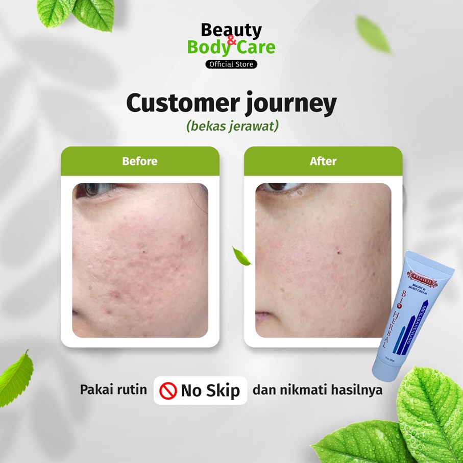 Cream Penghilang Bekas Jerawat Obat Salep Krim Penghilang Menghilangkan Bekas Jerawat Hitam Ampuh Pria Wanita Cowok Cewek