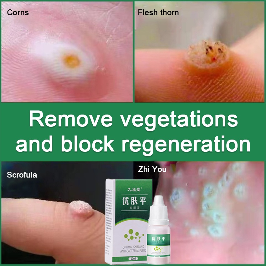 Cairan Obat Untuk Kutil Plester Kutil Mata Ikan Kaki Kapalan Ji Yan Gao Obat Kutil Kapalan Mata Ikan Kaki Callusol / Calusol / Kalusol (Mata Ikan Kalusol, Obat Kutil)