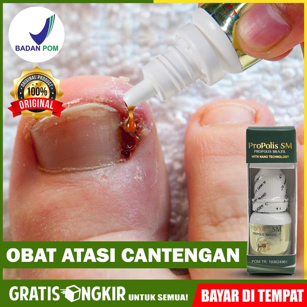 Jual Obat Tetes Untuk Obati Cantengan Cantengan Di Jempol Kaki