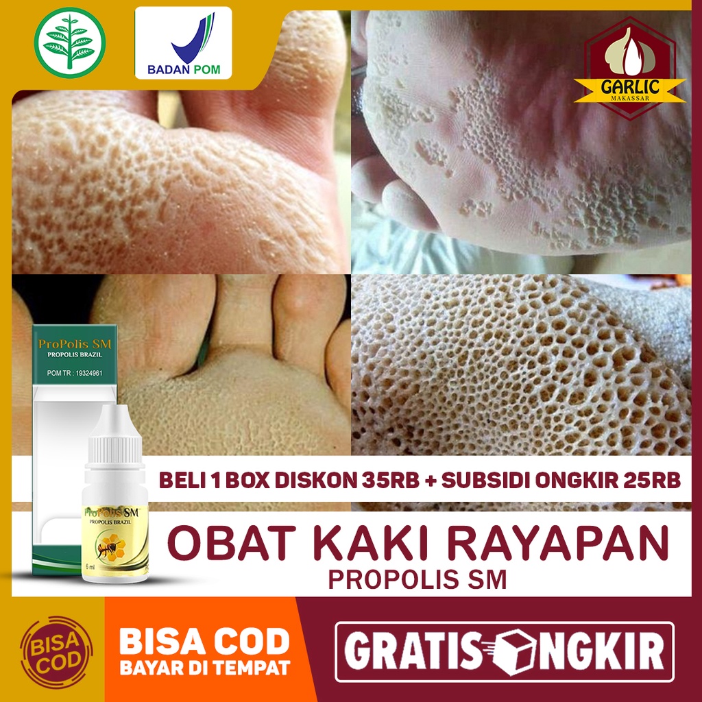 Obat Kaki Rayapan, Telapak Kaki Bolong Berlubang, Pecah, Kering Dan Berbau Pitted Keratolysis, Sakit