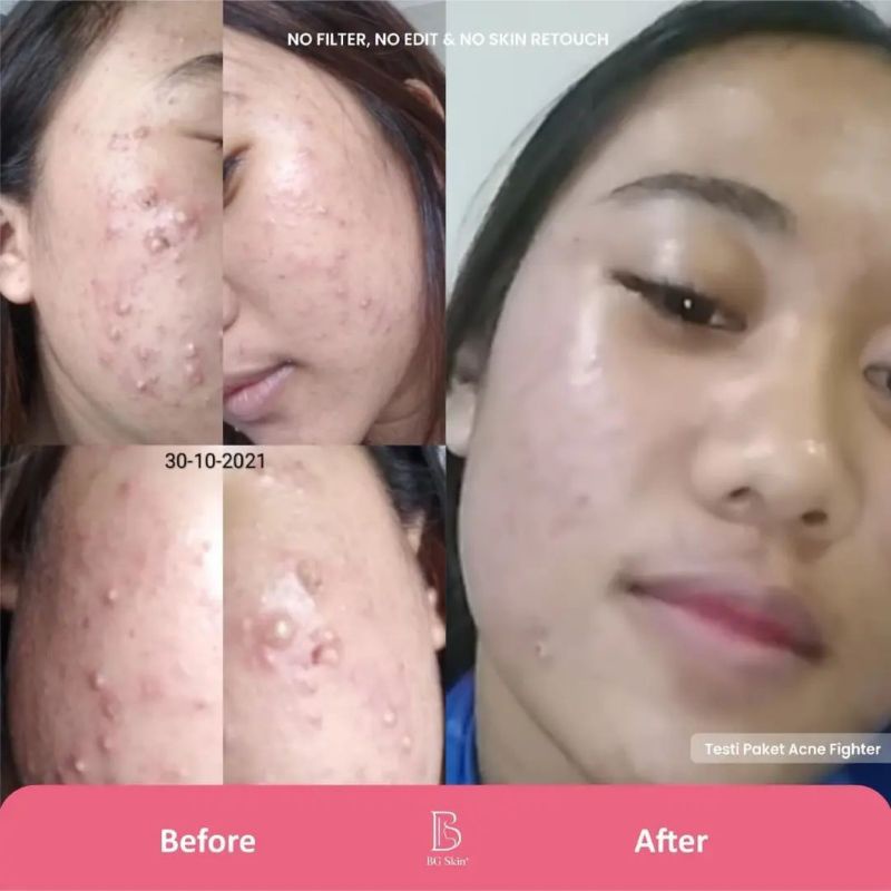 BG SKIN PAKET WAJAH PAKET ACNE FIGHTER JERAWAT MERADANG / BATU