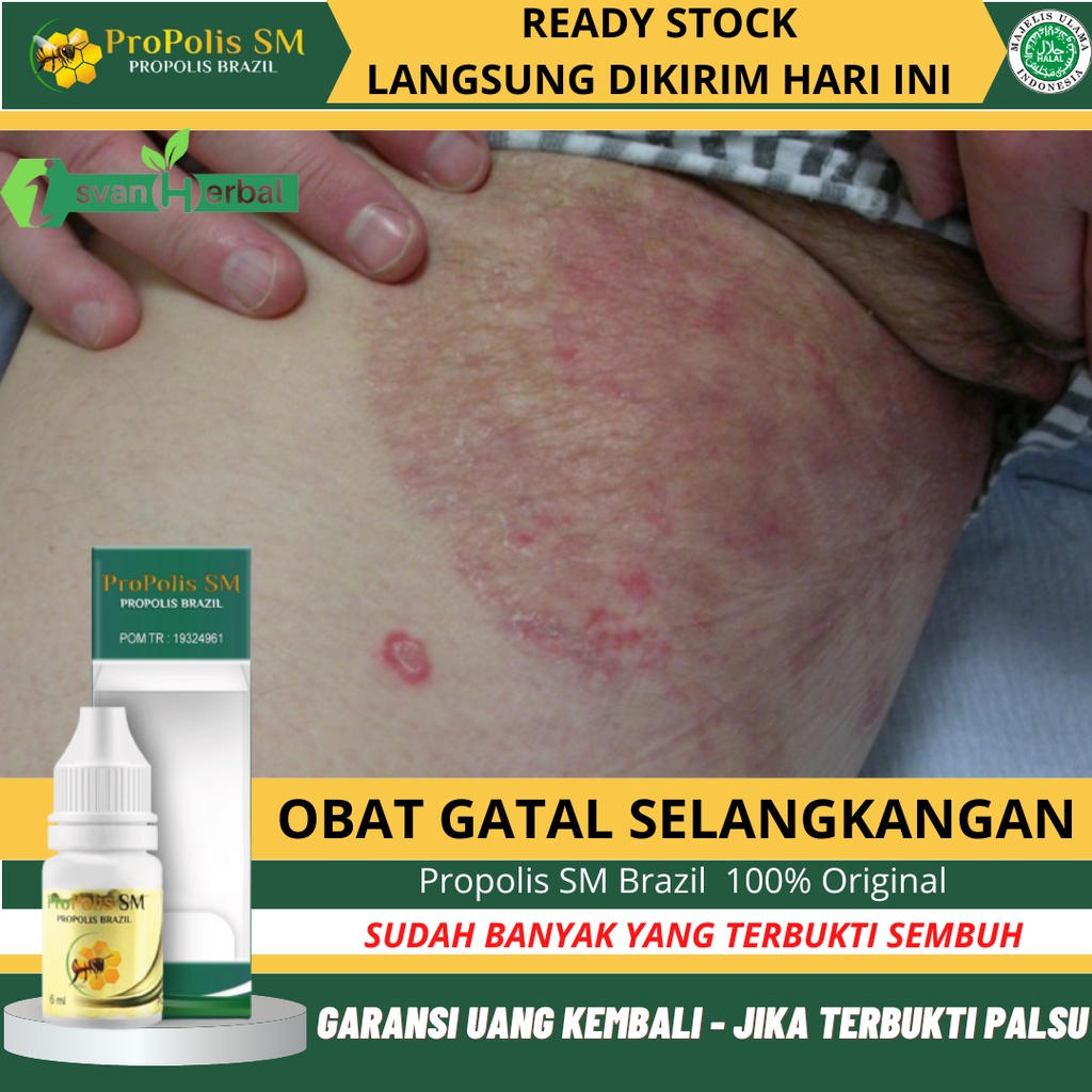 Obat Selangkangan Hitam Dan Gatal, Memutihkan Kembali Selangkangan Hitam, Selangkangan Lecet, Penghilang Selangkangan Berwarna Hitam Dan Kering Akibat Jamur, Pemutih Selangkangan, Infeksi Jamur, Gatal Pada Kemaluan, Gatal Pada Pantat Dengan Propolis SM