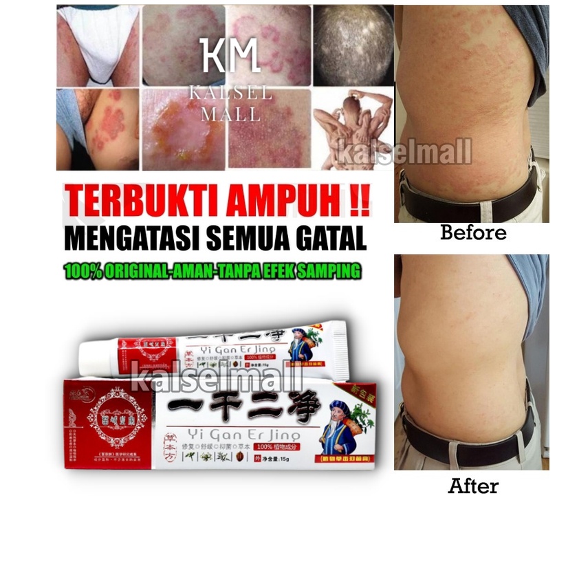 Salep Cream Krim Krem Obat Salap Gatal Yiganerjing ORIGINAL 100% Alergi Jamur Panu Kadas Ruam Eksim Selangkangan Jamuran Jerawat Kudis Korengan Kurap Kutu Air Psoriasis Skabies Panuan Keputihan Cina Herbal Tradisional OC13