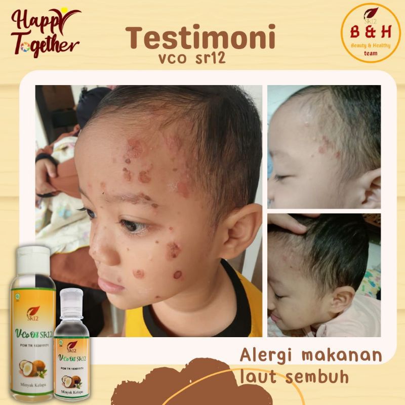 VCO SR12 Untuk Ruam Popok / Minyak Bayi / Biang Keringat / Minyak Kelapa Untuk Bayi / Obat Eksim Bruntusan Dermatitis Kulit Berkerak Bayi Anak