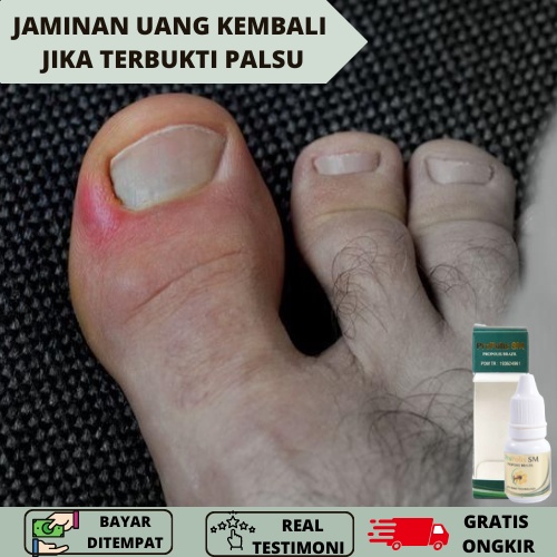 Obat Jamur Kuku Cantengan, Obat Herbal Cantengan, Obat Cantengan, Obat Cantengan Jempol Kaki, Obat K