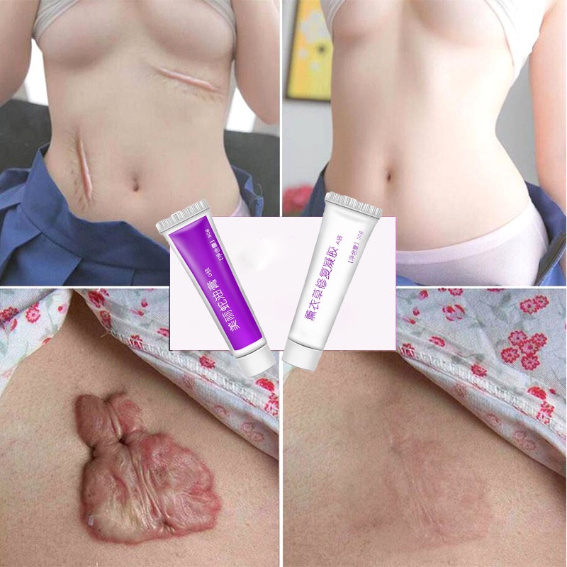 Krim penghilang bekas penghilang bekas luka penghilang bekas jerawat 60g Menghilangkan bekas luka dengan cepat dan lembut stretch mark bekas jerawat mengembalikan kulit halus