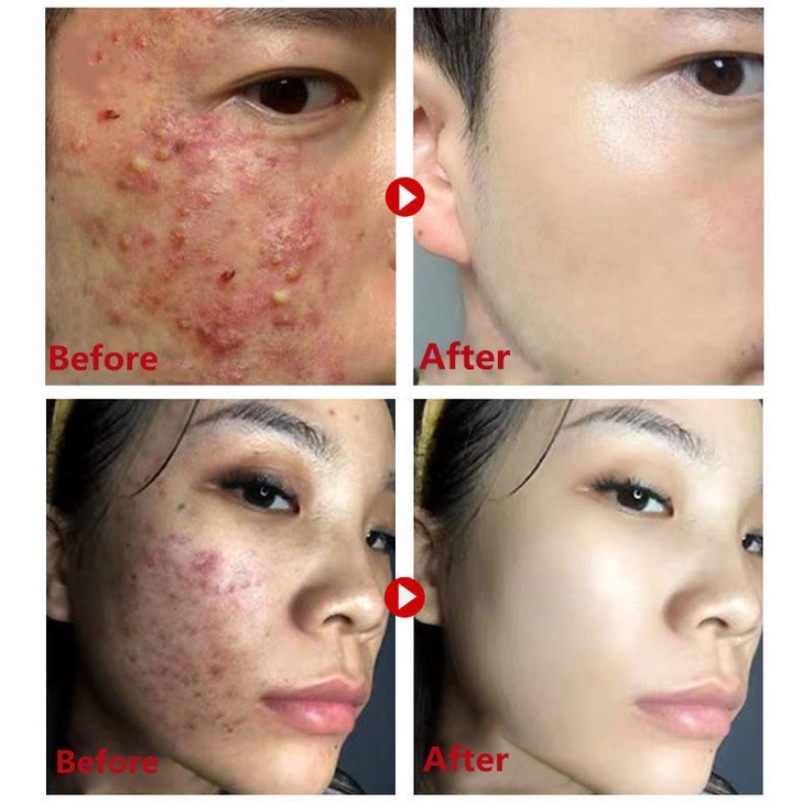 cream jerawat obat totol jerawat krim jerawat obat jerawat dan bekas jerawat Jerawat Removal of Acne Cream Untuk Pria dan Wanita Menghilangkan jerawat dengan cepat