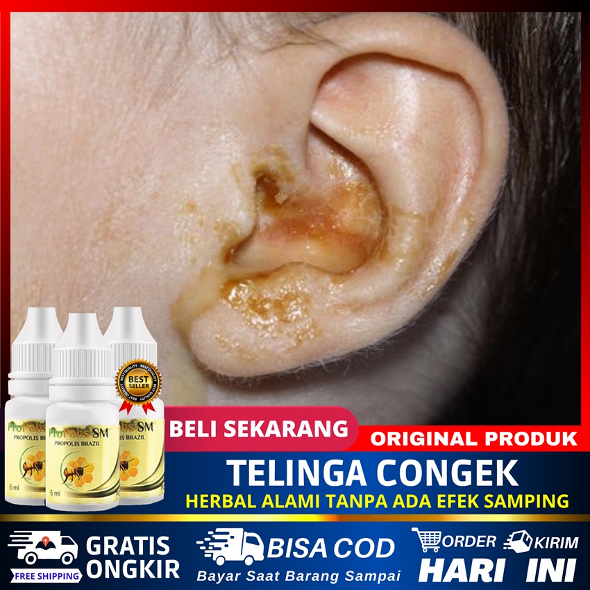 Jual Obat Telinga Bernanah Berair Bau Congean Budeg Kuping berdengung