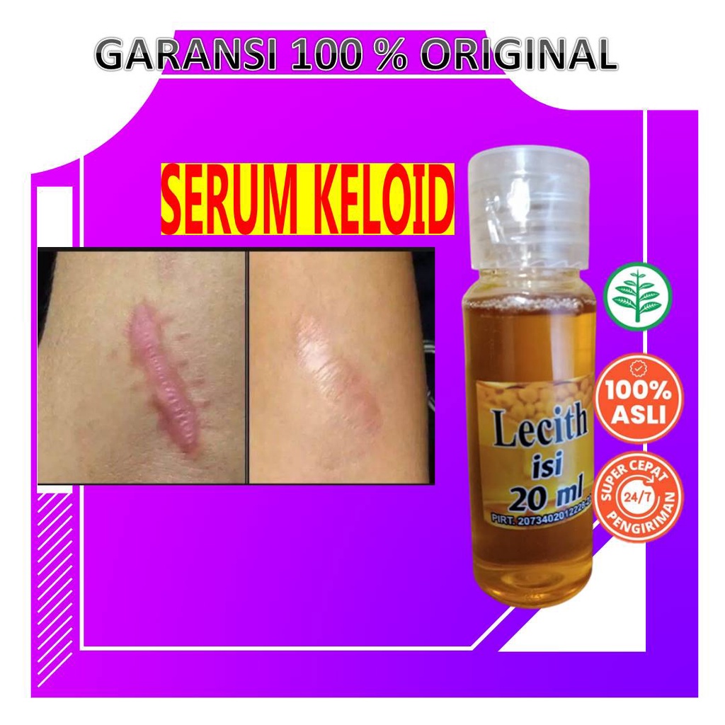 Minyak Obat Penghilang Keloid Yang Sudah Lama Luka Bakar Bagus Scar Krim Keloid Salep Serum Obat Pen