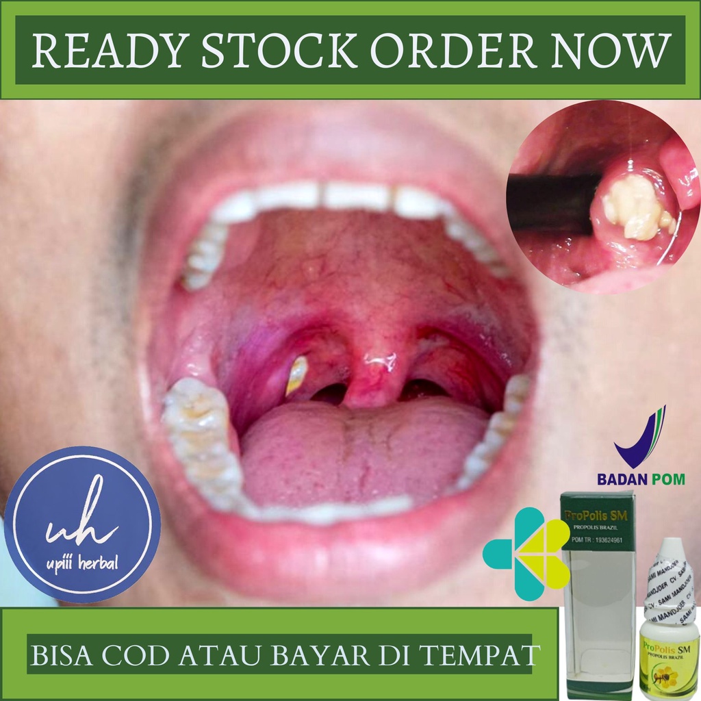 OBAT PENGHILANG BATU AMANDEL, OBAT AMANDEL, OBAT PEMBENGKAKAN AMANDEL, OBAT ALAMI UNTUK AMANDEL, OBA