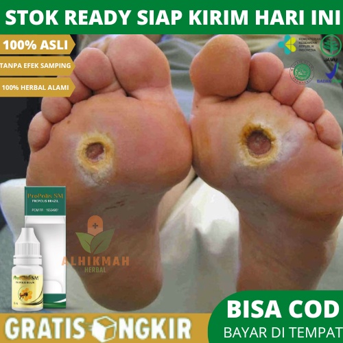 Obat Luka Diabetes, Obat Luka Diabetes Gangrene, Gangren, Obat Luka Diabetes Agar Cepat Kering, Obat