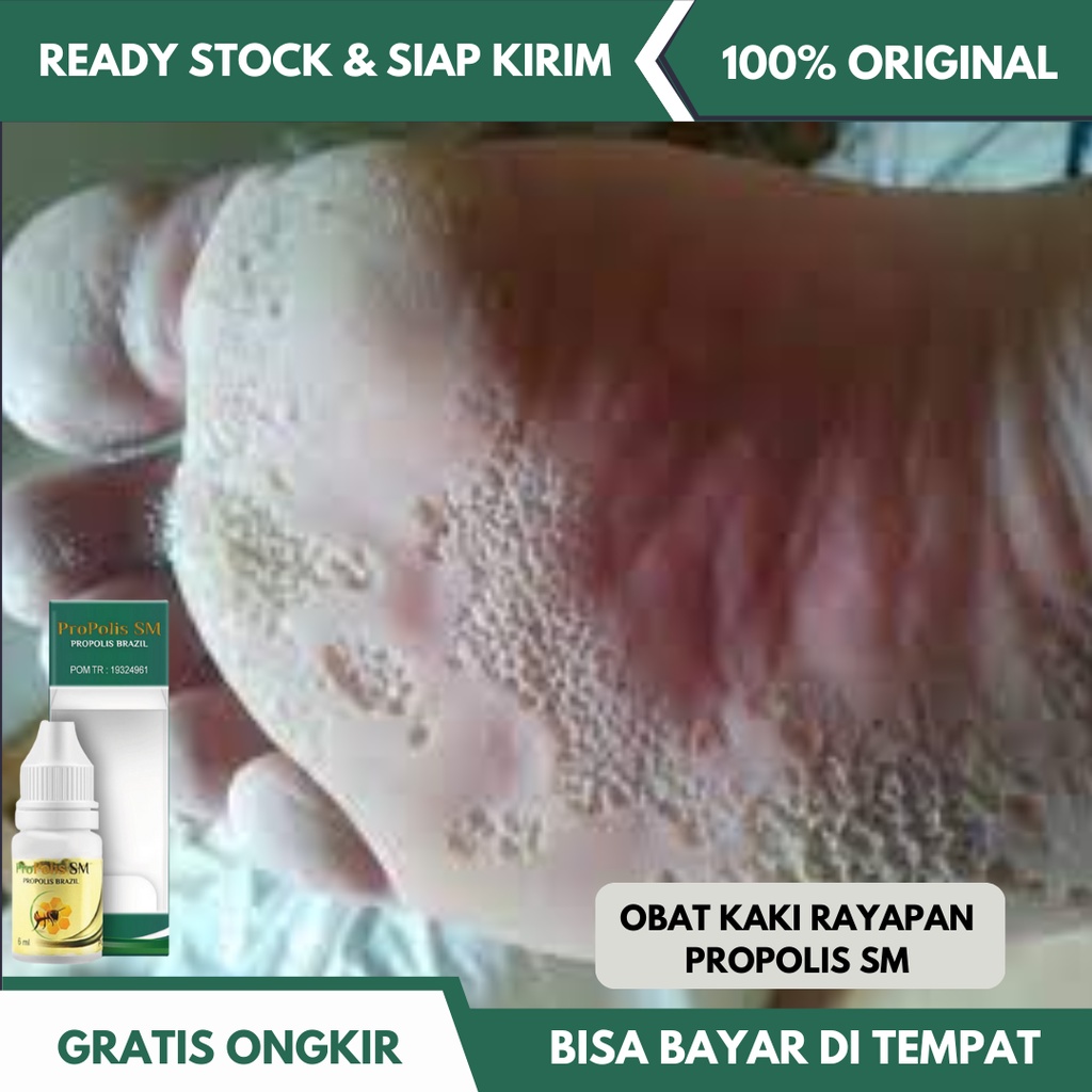 Jual Obat Mengatasi Telapak Kaki Rayapan Salep Kaki Bolong Bolong Obat Oles Telapak Kaki