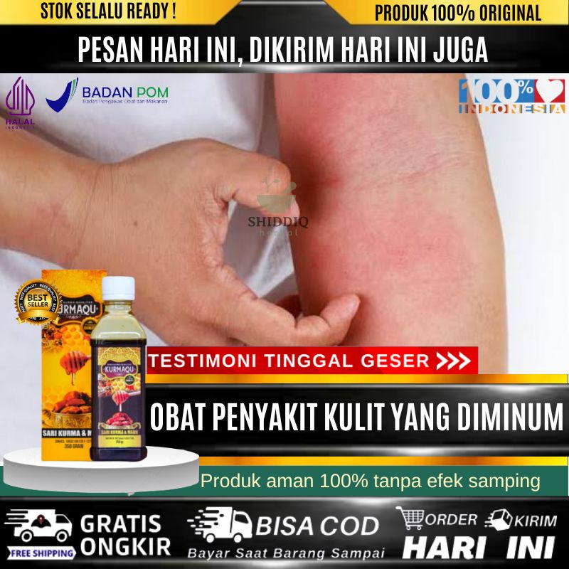 Obat Penyakit Darah Manis - Ruam Kulit - Gatal Gatal Pada Kulit - Buduk - Daging Manis - Darah Manis