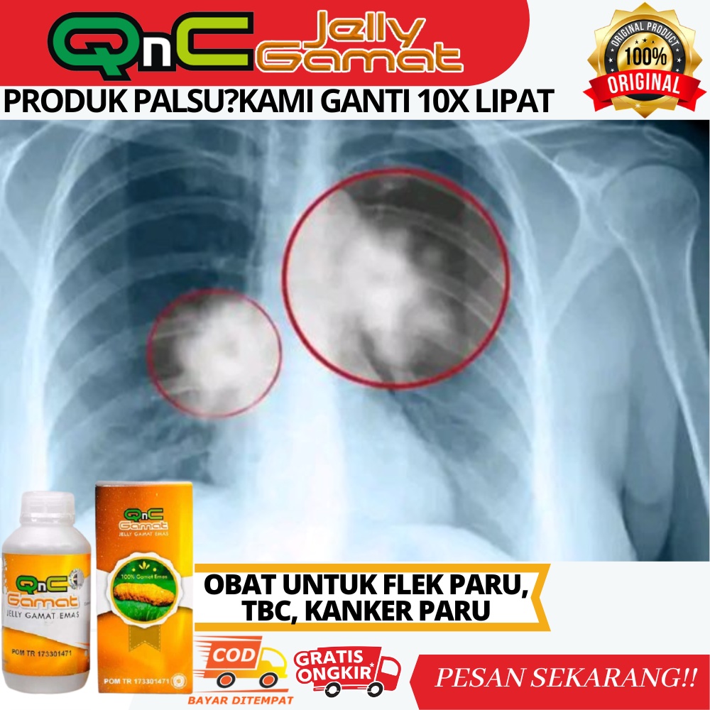Obat Flek Paru Paru, Flek Paru Anak-anak, Dewasa, TBC, Tuberkulosis Anak dan Dewasa, Obat Herbal Kan