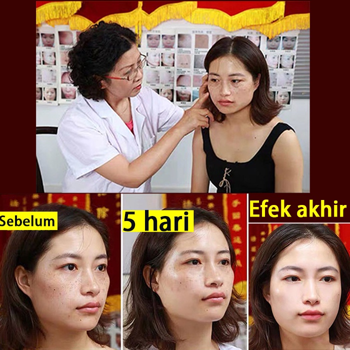 Penghilang flek hitam di wajah ampuh bpom menghilangkan bintik bintik di wajah Melasma Ampuh Remedy Black Spots tanpa melukai kulit Whitening Freckle