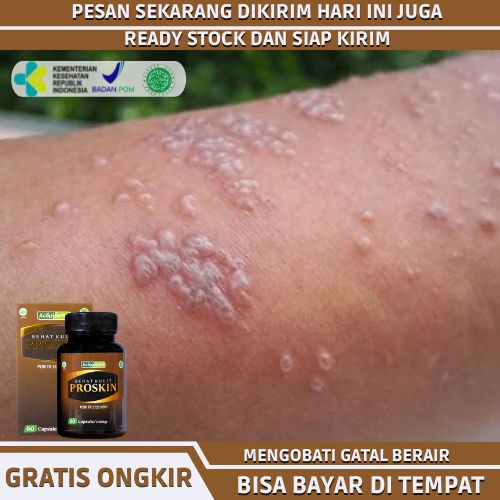 Obat Gatal Berair, Obat Herbal Bintik Bening Berair, Obat Iritasi Pada Kulit, Obat Tradisional Gatal