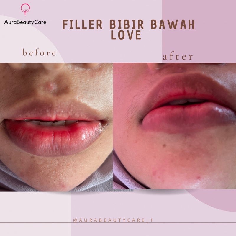 filler bibir love