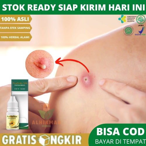 Obat Bisulan, Obat Bisul, Obat Bisul Bernanah, Obat Benjolan Bernanah, Bisul Di Pantat, Bisul Di kak