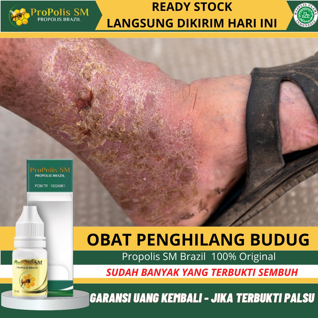 Obat Gatal Budug, Obat Penghilang Budug, Obat Budug Santri, Obat Tetes Budug Bernanah, Obat Borok Bernanah, Salep Budug, Obat Salep Gudik, Borok, Koreng Bernanah, Cenang, Obat Kaki Budug, Gatal Gatal, Selangkangan Gatal, Kulit Berjamur - Propolis SM