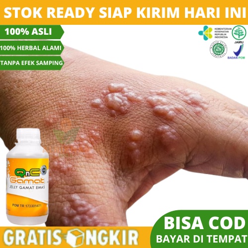 Obat Herpes Kulit, Obat Gatal Herpes, Obat Kulit Gatal Herpes, Obat Herpes, Obat Herpes Untuk Anak D