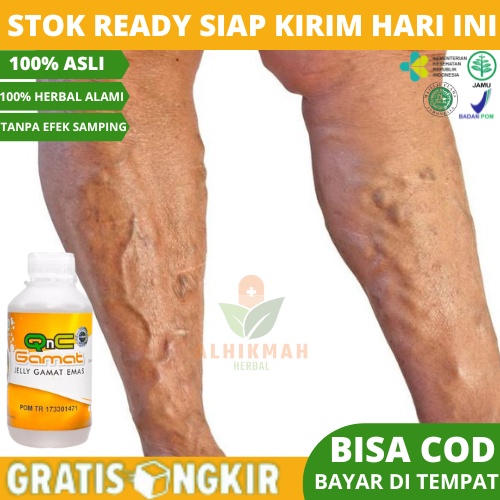 Obat Varises, Obat Varises di Kaki dan Betis, , Varises Di Tangan, Varises Di Betis, Obat Pelancar P