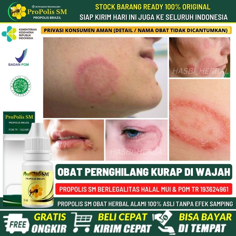 TERLARIS  Obat Penghilang Kurap & Bekasnya di Wajah, Obat Kurap Kudis Kadas Gudik Gudig Ruam Merah d