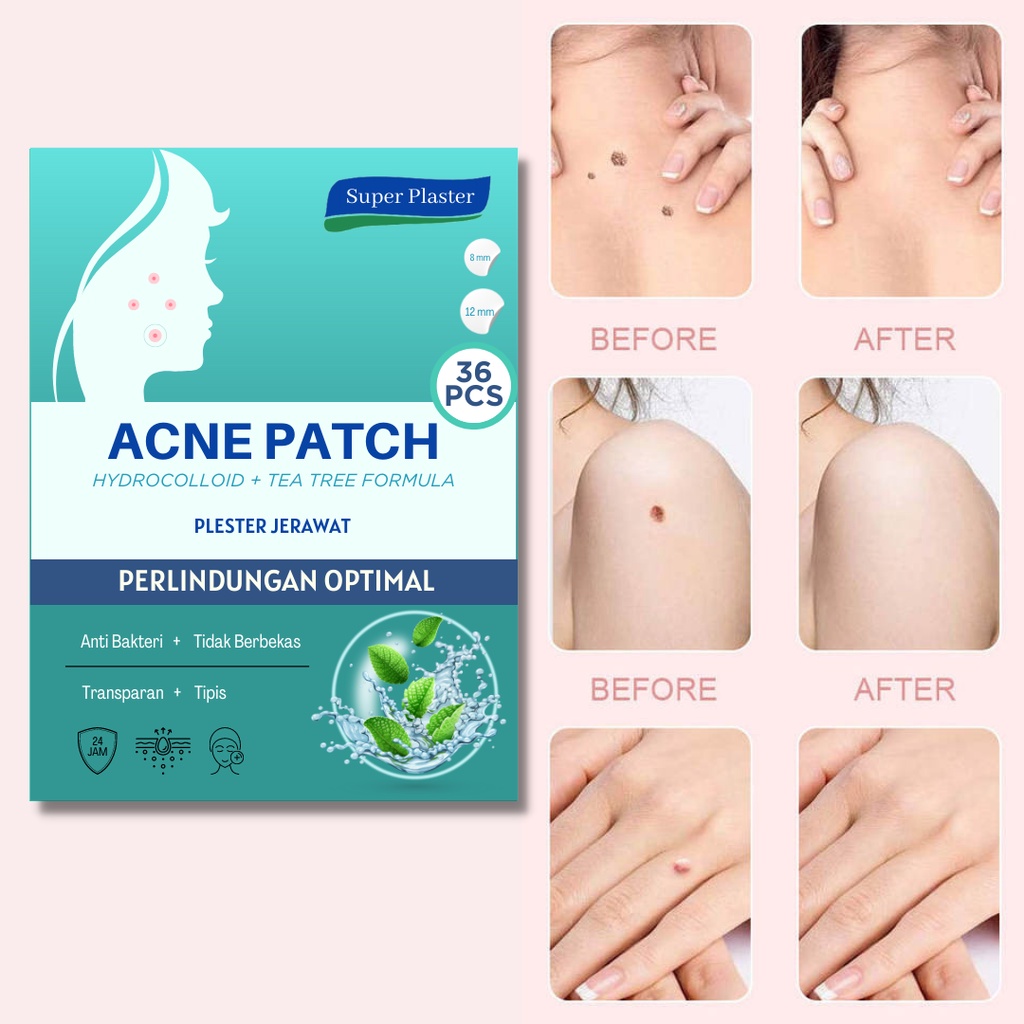 Original Sticker Jerawat Acne Patch / Obat Jerawat - Penghilang Jerawat Super Tipis Acne Treatment Day/Night