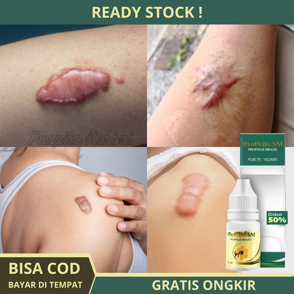 Obat Keloid - Obat Keloid Daging Tumbuh - Obat Keloid Menahun - Obat Penghilang Keloid - Obat Keloid