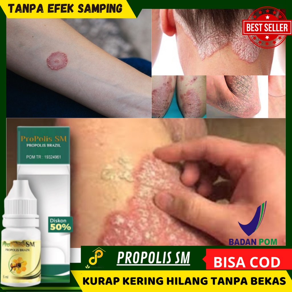 Obat Kulit Kering Bersisik Gatal Mengelupas - Kurap Kering Berbentuk Cincin - Salep cair Menghilangk