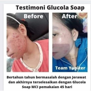 Sabun Pencuci Muka untuk berjerawat, berminyak Glucola Soap MCI isi 6 atau satuan