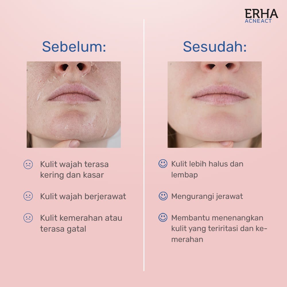 ERHA Pelembab Wajah Jerawat - Gentle Acne Moisturizer ~ ORIGINAL 100%