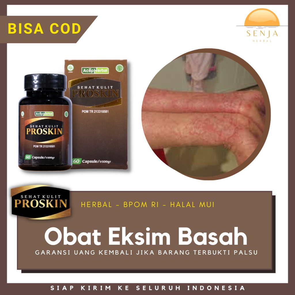 Obat Eksim Basah Menahun, Obat Herbal Eksim Basah, Obat Infeksi Kulit, Obat Radang Kulit | PROSKIN