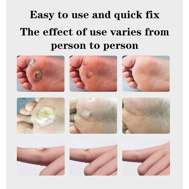 Obat mata ikan penghilang kutil Obat kutil kelamin 10ml Obat cair antibakteri kutil tangan dan kaki Menghilangkan Mata Ikan Di Kaki 100% Herbal Alami