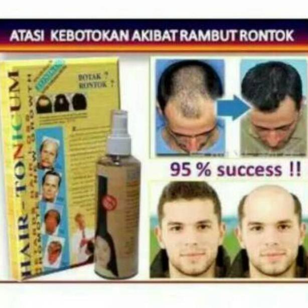OBAT PENUMBUH RAMBUT BOTAK SERUM PENUMBUH RAMBUT KEPALA –UZB.22Oc22ι
