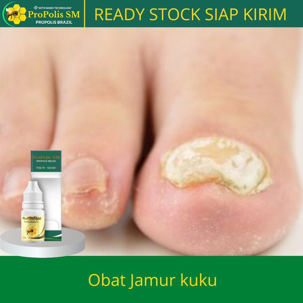 Salep Original Propolis SM Obat Untuk Menghilangkan Jamur Kuku, Obat Jamur Kuku Tangan Murah, Obat K