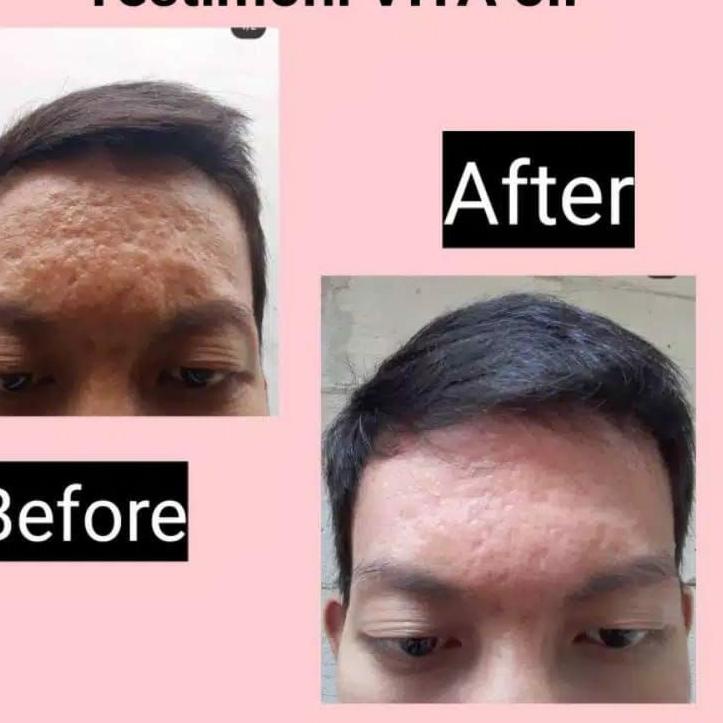 [PRODUK WTBR8] VITA OIL PENGHILANG FLEK HITAM,BOPENG, JERAWAT BEKAS NYA ORIGINAL VJQ