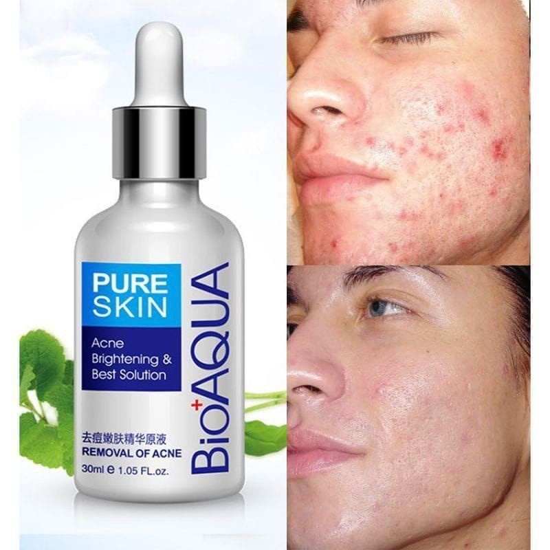 Medan Termurah Original Hempas jerawat Pure skin acne essence/Serum Penghilang jerawat