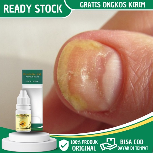 Obat Pitting Kuku - Obat Psoriasis Kuku - Obat Infeksi Jamur Kuku - Obat Kuku yang Rusak - Obat untu