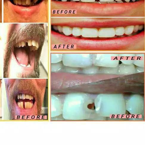 tambal gigi,gigi kelinci,gigi gingsul instan murah